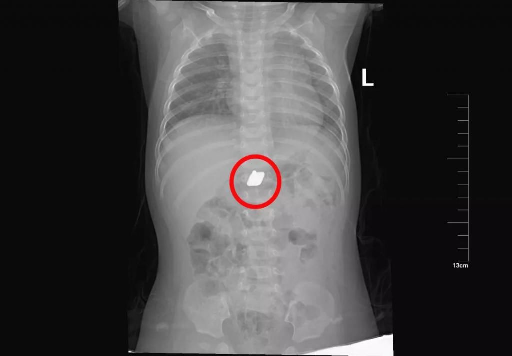  真相|有图有真相：那些年，孩子体内发现的硬币、钥匙、钉子、别针、电池……