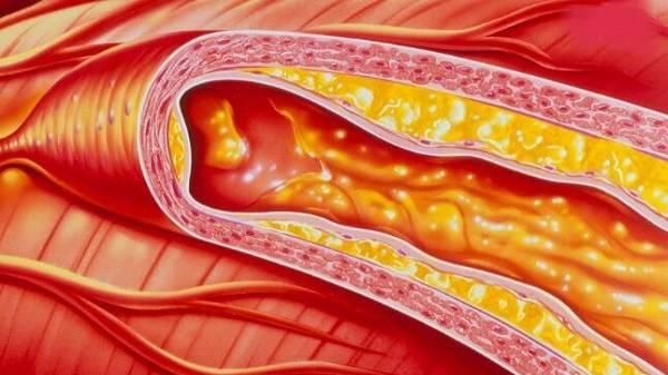 血脂|血脂反复降不下来？用中医古法调理，血脂一干二净