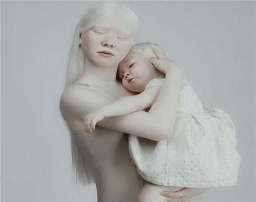  惊艳|罕见的“白雪公主”，却遭受了14年冷眼，拍完一组照片后惊艳全球