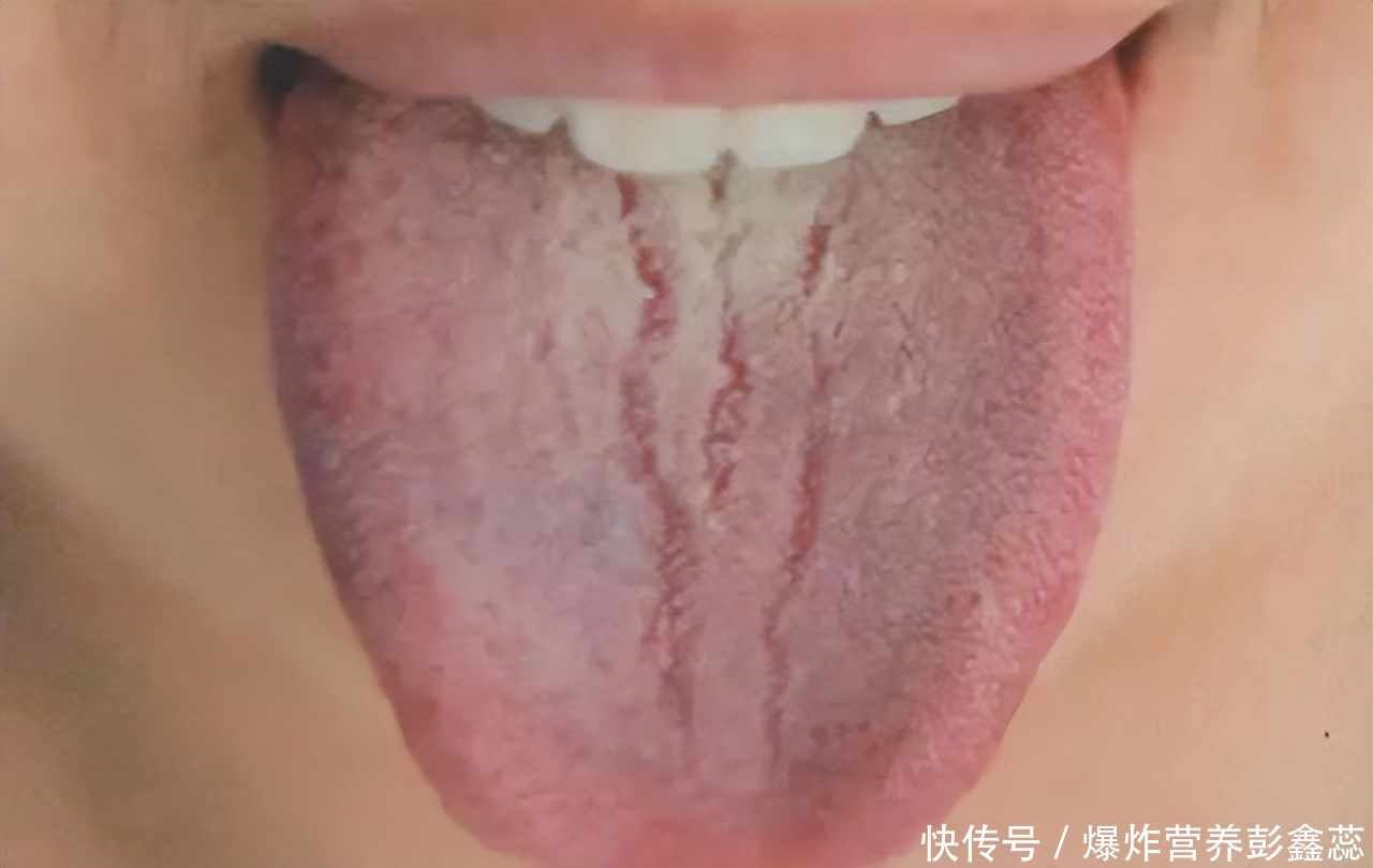 舌头脾胃处有裂纹是怎么回事(舌头上有裂纹，是因为脾胃差？出现裂纹舌，有这3种根本原因)