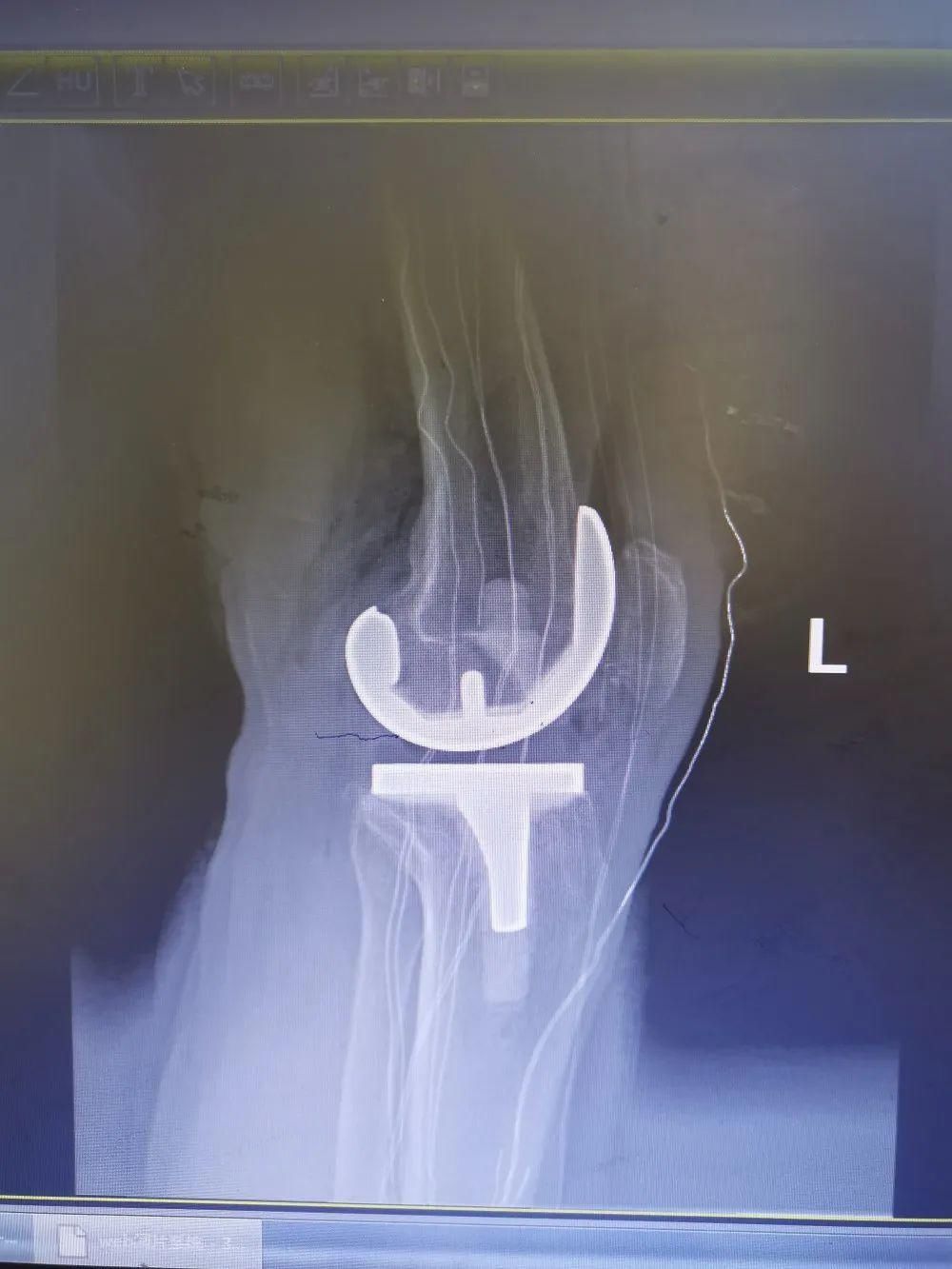 身患|身患双膝骨性关节炎10年的古稀老人最近又能愉快的行走了