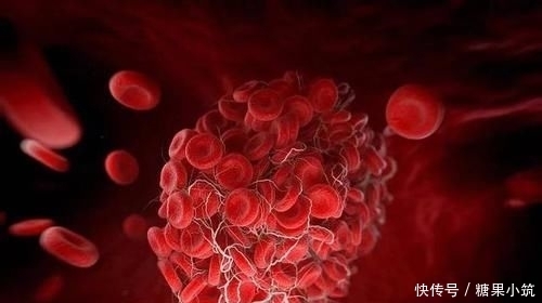 血栓|半瓶醋加上“它”是血栓的“死对头”,让你的血管一通到底!