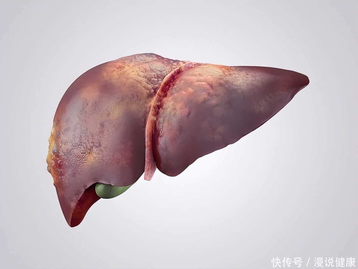 脂肪肝会诱发痛风吗(痛风为何常常伴有脂肪肝？遇上两者相撞，建议不妨做好这3件事)