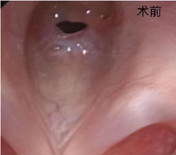 小孩气管狭窄手术能彻底治愈吗(小女孩手术后气管狭窄，医生再次采用同样手段引家属质疑)
