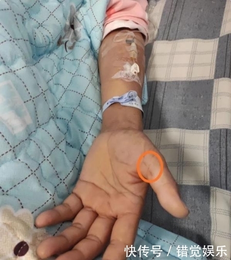 脑脊液|一女子在处理猪肉时被刺破手,患罕见疾病!全国仅见200多例