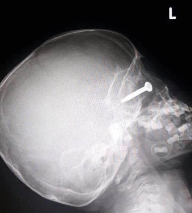  螺丝钉|泰男孩花园玩耍，父亲的割草机突然飞射螺丝钉，直刺眼球深插头骨