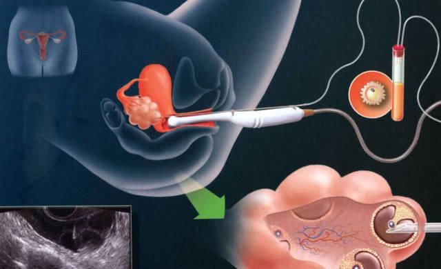  告诉|试管婴儿的寿命有多长？医生不会告诉你，但准妈妈最好心里有底
