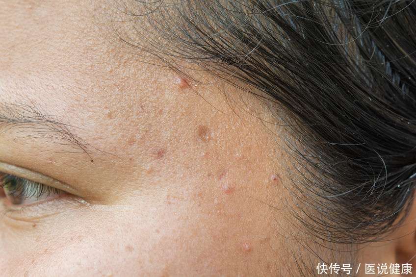 头皮上长红疙瘩是怎么治疗(头皮上长红疙瘩，或是这5个原因引起的，需重视，要及时治疗)