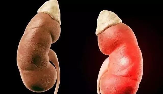  尿酸|38岁男子，尿酸高达820，确诊肾衰竭，这种饮品不能当水喝