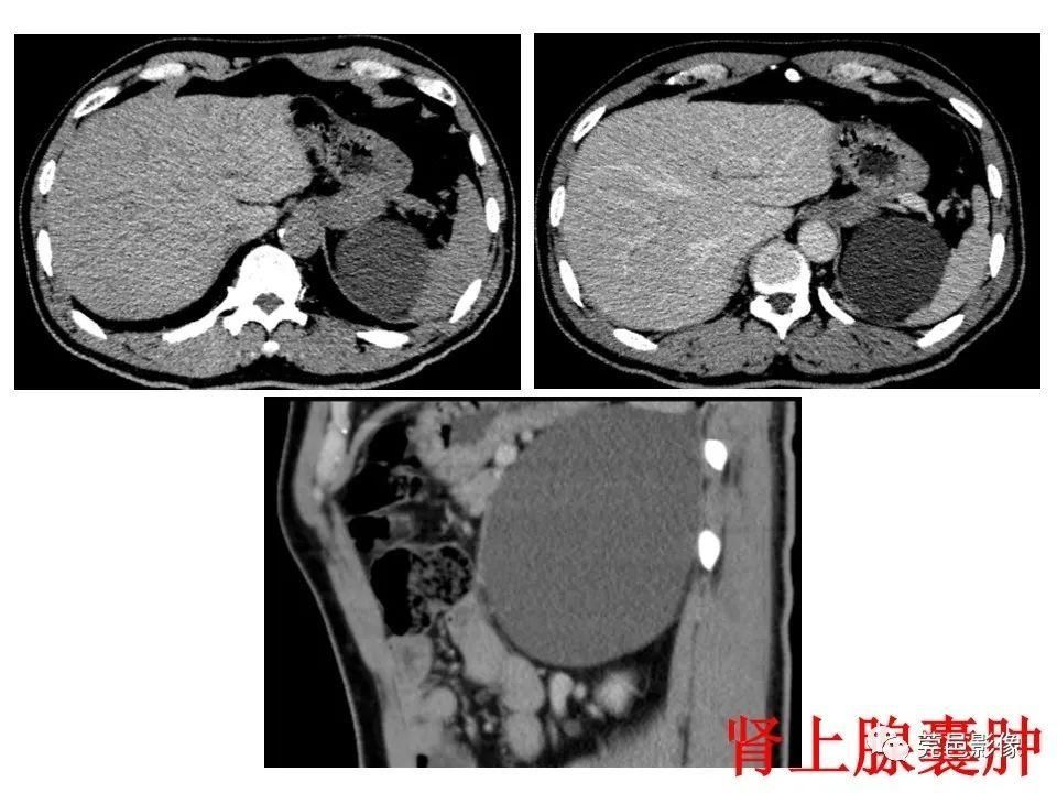 畸形|胃重复畸形CT诊断与鉴别诊断