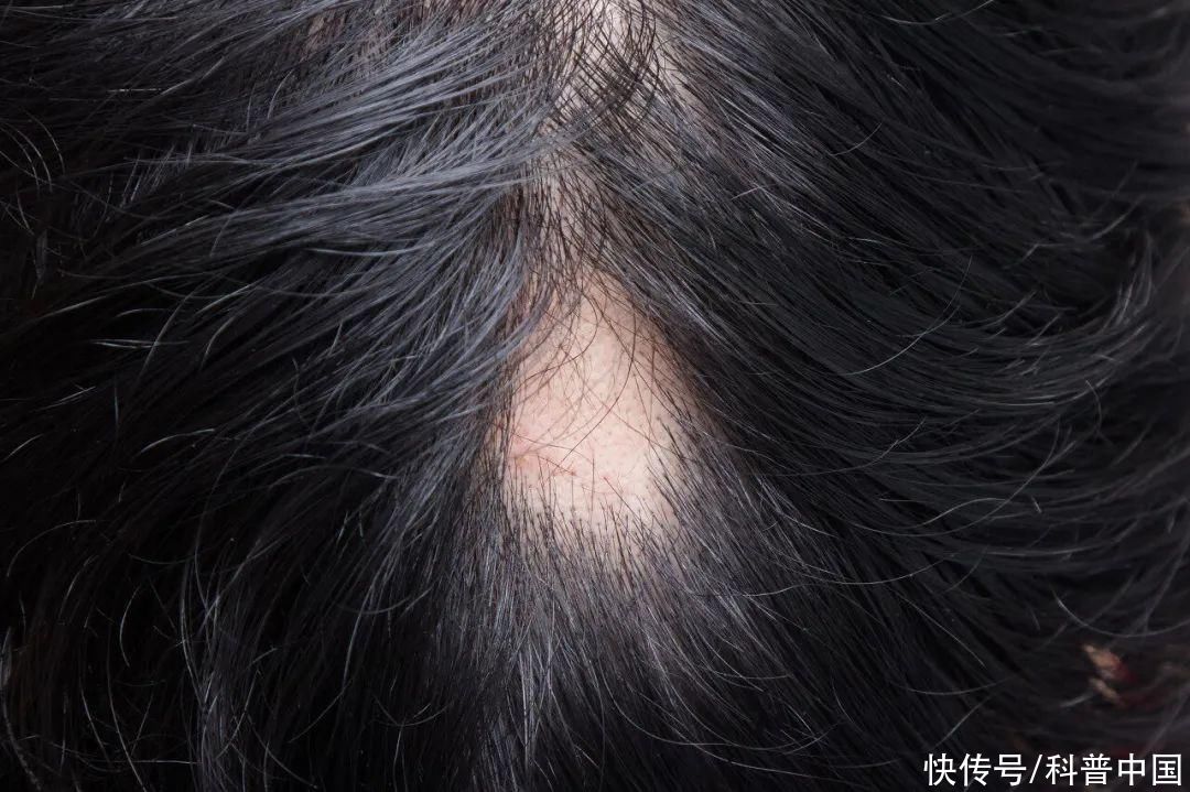 头上突然秃了好几块是鬼剃头吗(头上突然秃了好几块，是“鬼剃头”吗？)