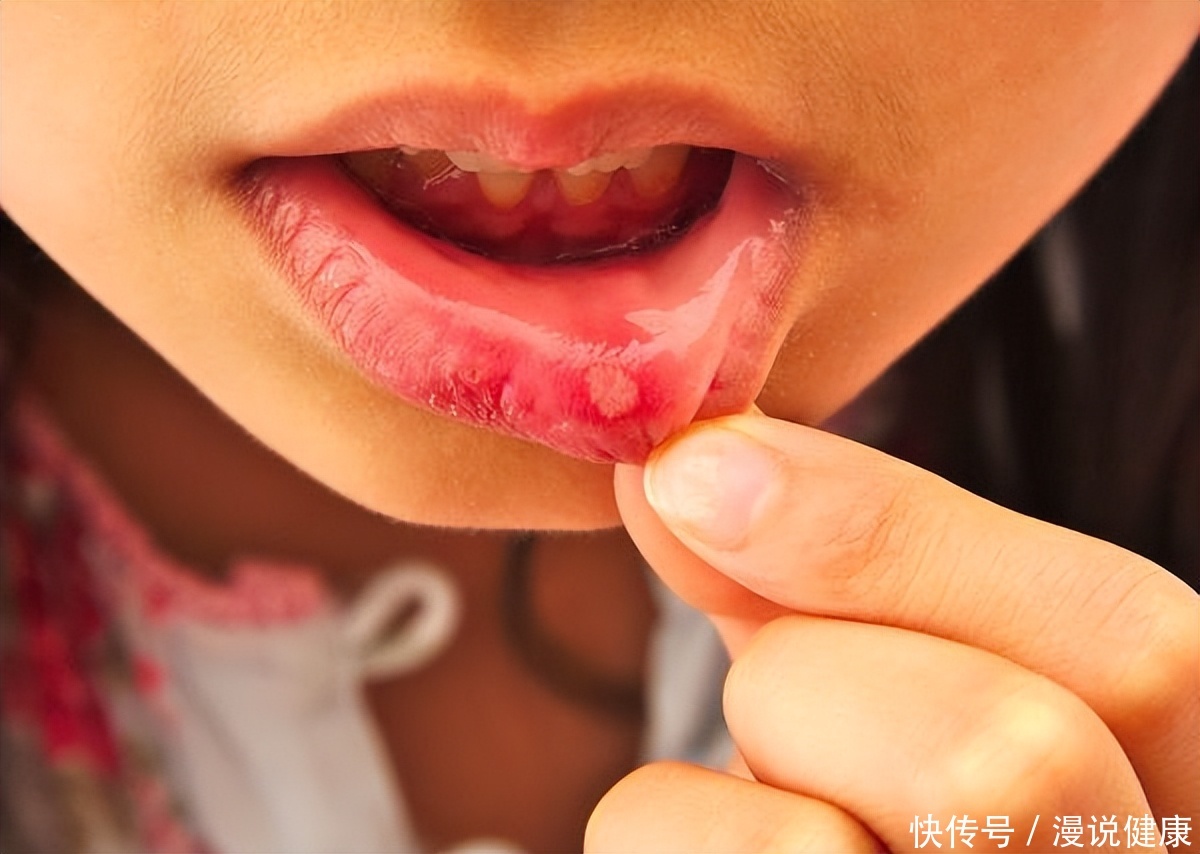 口腔溃疡与口腔癌如何区别(口腔溃疡还是口腔癌？要想辨别这两者，建议从这6个部位入手)