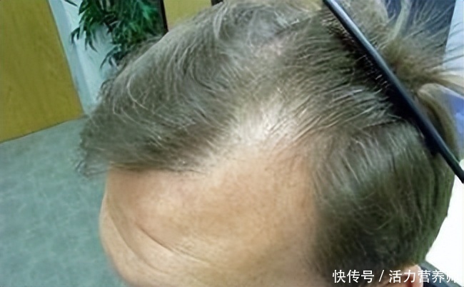 为什么脱发部位大多是前额和头顶(为什么中年脱发的人，总是先从头顶和前额开始？原因在这里)