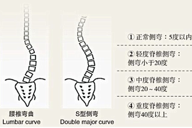  别晚|多数孩子存在“脊柱侧弯”，问题在于父母，矫正别晚于这个时间