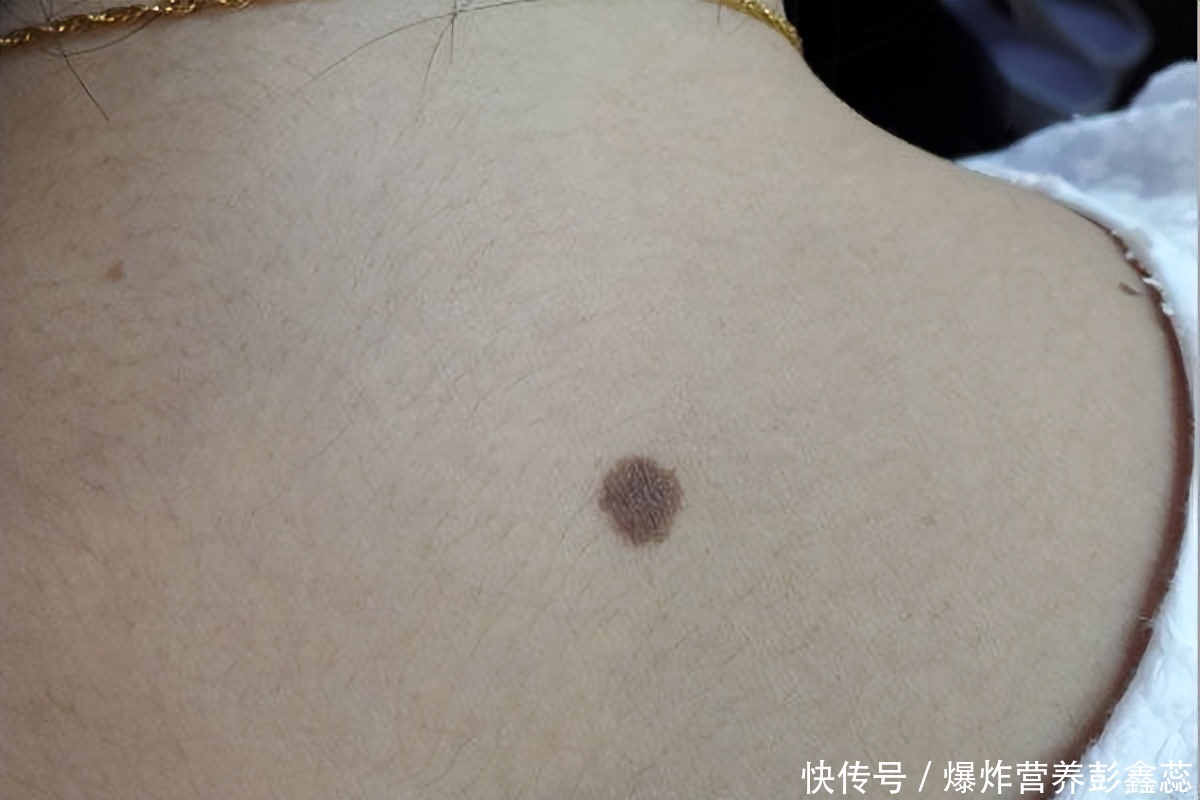 长在这几个地方的黑色痣，或是身体异常的表现，不能再忽视了2023