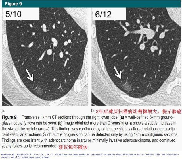  结节|肺结节切还是不切？20张经典图谱说明白了！