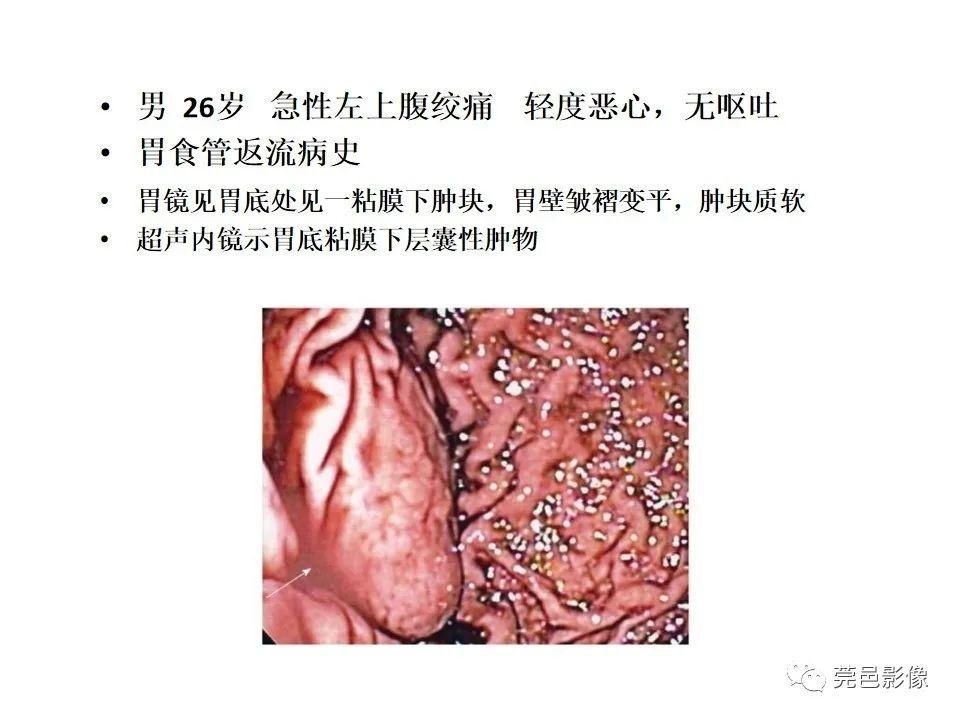 畸形|胃重复畸形CT诊断与鉴别诊断