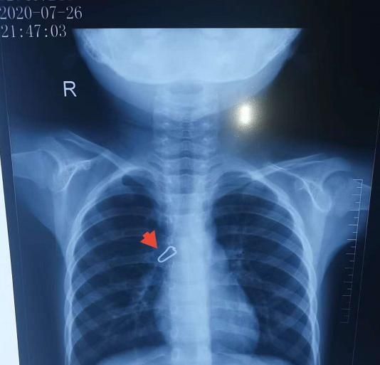  面汤|喂7个月大幼儿喝面汤，竟让这个东西卡进气管！