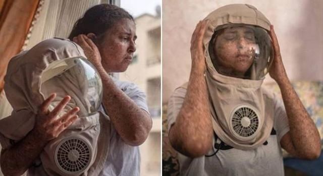  防护|对紫外线过敏导致退学 英国28岁女子出门必须戴防护面具