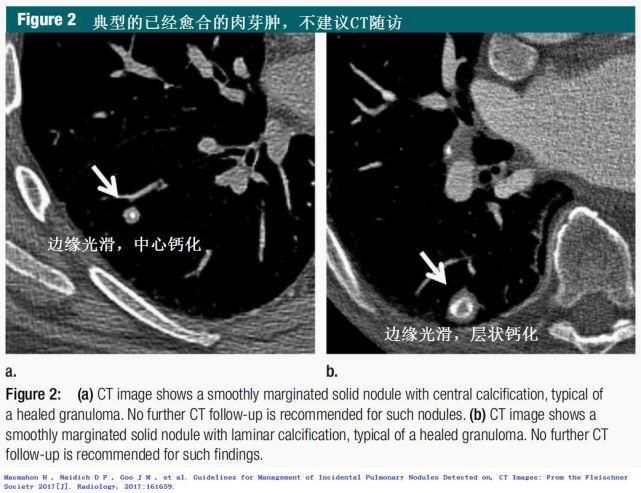  结节|肺结节切还是不切？20张经典图谱说明白了！