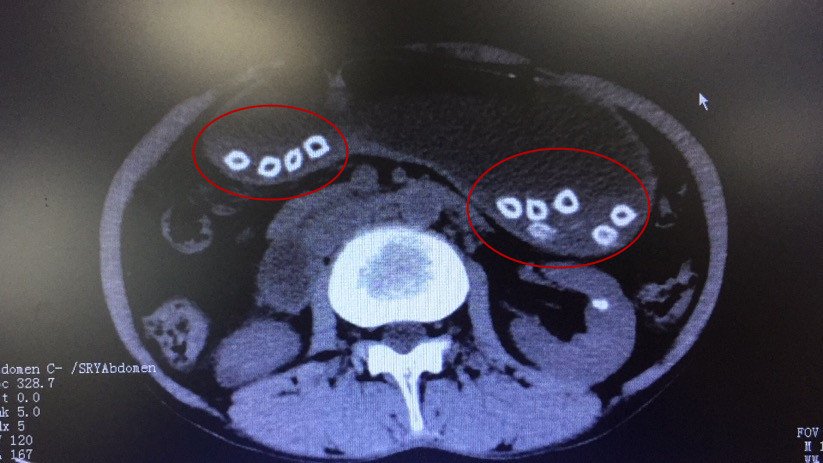  男子|吃杨梅不吐核？男子腹痛难忍取出32颗杨梅核，医生表示杨梅带核吞下不可取