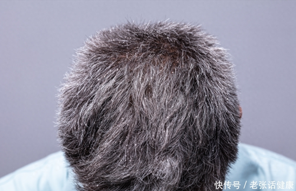 白头发越长越多是缺少哪些营养(白头发增多，未必是衰老了，或是体内缺乏4种营养素，要及时补充)