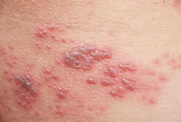  盯上|痛如刀割：带状疱疹又叫缠腰蛇，6类人容易被“盯上”，及时治疗
