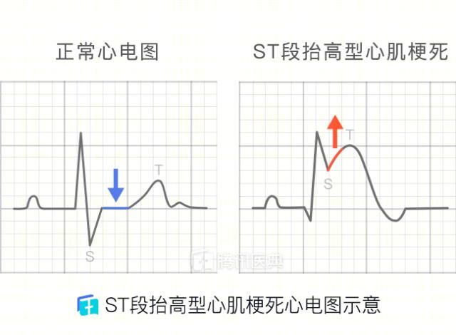  心梗|心梗了，该不该开通“非罪犯血管”？医生：要考虑这些因素！