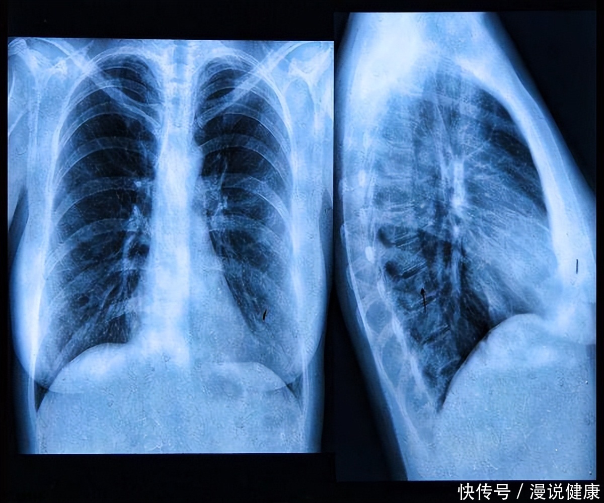 癌症筛查能查出早期乳腺癌吗(乳腺癌筛查最好用CT？关于癌症早筛的4个误区，最好事先了解下)