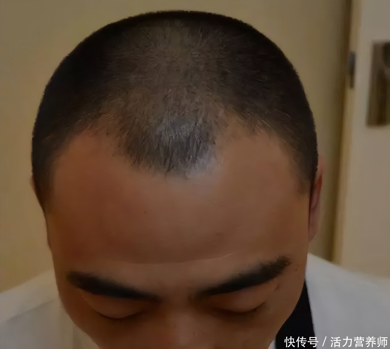为什么脱发部位大多是前额和头顶(为什么中年脱发的人，总是先从头顶和前额开始？原因在这里)