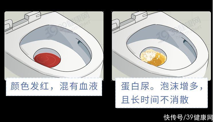 肾衰突然尿多了是怎么回事(肾衰来临，小便知道？提醒：小便出现3种异常，可能是肾衰信号)