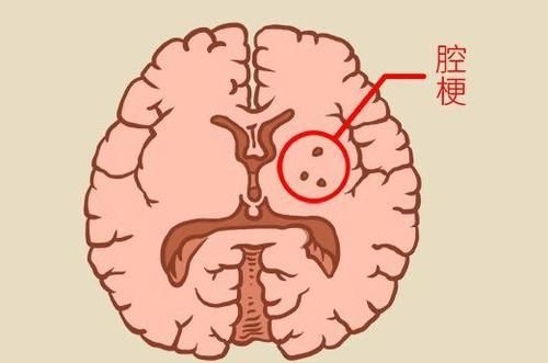  先兆|头晕、手发麻、言语不清？是脑梗先兆！4种食物让大脑年轻10岁
