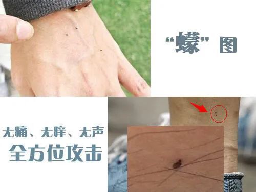  湘湖|杭州小伙去湘湖走了一圈，双腿被咬成这样！最近多人中招