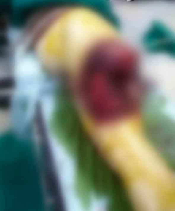 郑州人民医院|吓人！手机放裤兜爆炸险些炸断腿，这几大征兆一定要注意!