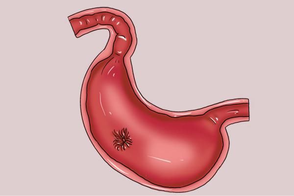  疾病|频繁放屁，真的是身体排毒？别忽视，也可能是疾病信号