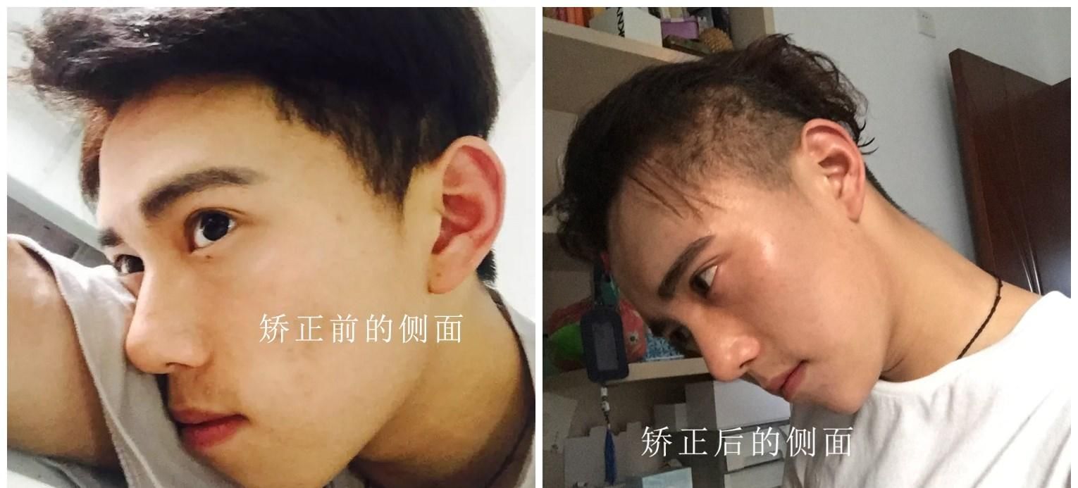  牙齿矫正|龅牙做完矫正后会有什么改变？