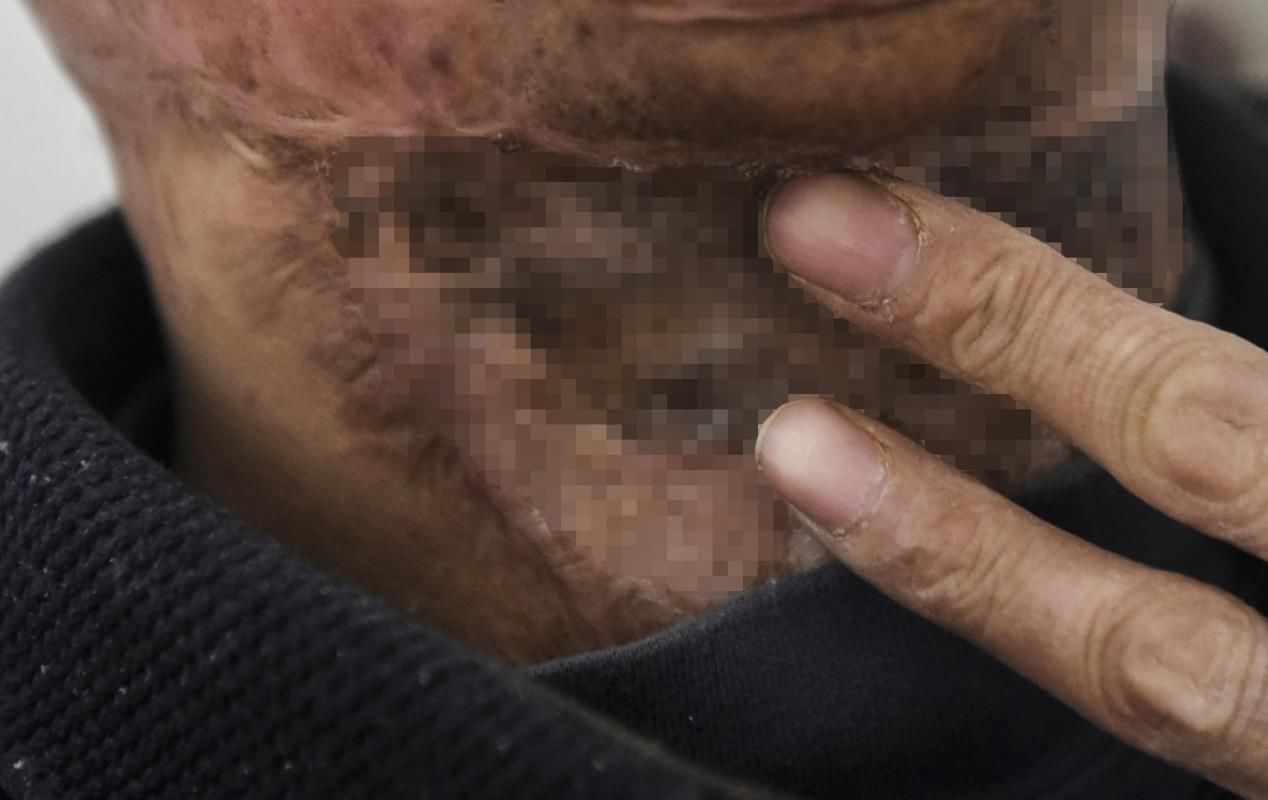  容貌|男子火中勇救2人曾获荣誉无数，帅气容貌被毁不敢见人