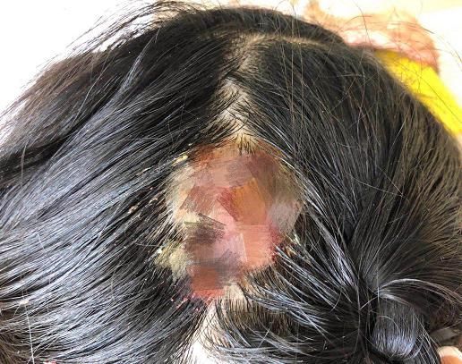 适合|8岁女孩大量掉发,医生提醒:这类人不适合撸猫撸狗