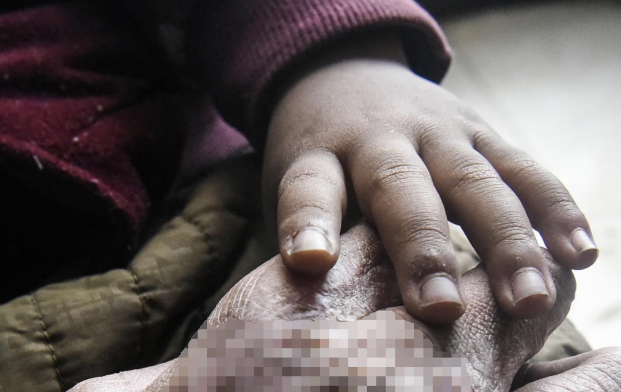  容貌|男子火中勇救2人曾获荣誉无数，帅气容貌被毁不敢见人