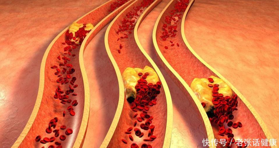 不吃油、不吃肉，饮食清淡，为何血脂还高？望你早点搞清楚2023