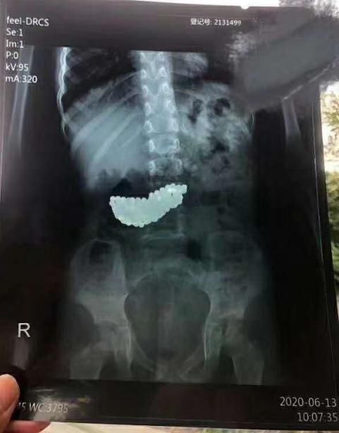  留置|济南一5岁女孩，误吞190颗巴克球，胃内留置俩月，胃镜全部取出后，医生惊呼奇迹……