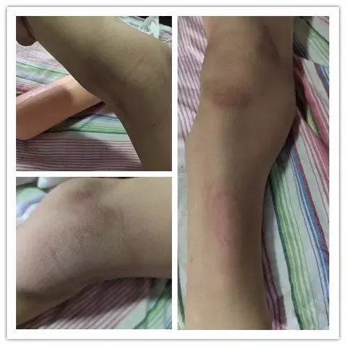  男孩|怒！酒驾将两岁男孩撞致截肢！67万赔偿苦等7年还没来！