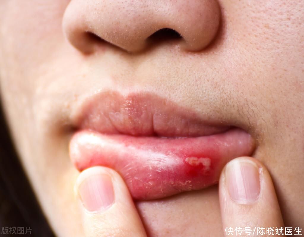 复发性口腔溃疡知柏地黄丸(复发性口腔溃疡很痛苦？不妨试试知柏地黄丸，接触困扰、吃嘛嘛香)