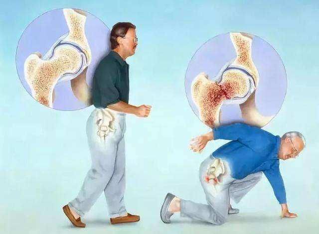  股骨颈骨折|七旬老人摔跤后未在意被送医，专家提醒警惕“隐匿性”骨折