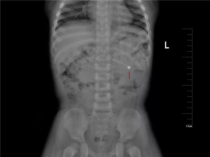  真相|有图有真相：那些年，孩子体内发现的硬币、钥匙、钉子、别针、电池……