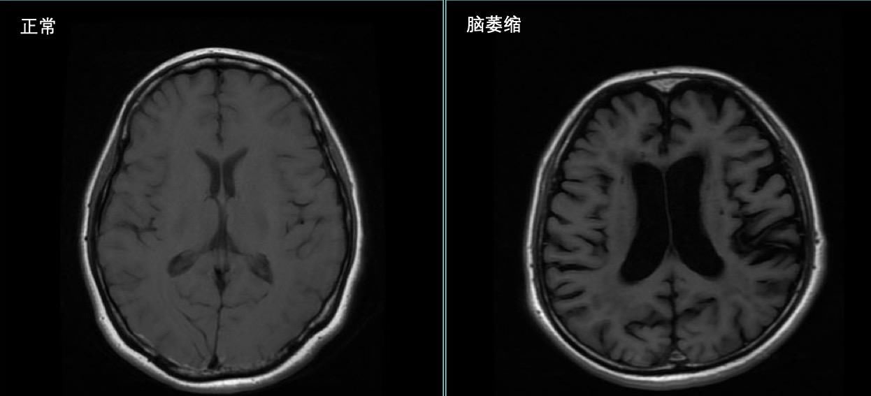  减退|记忆力减退，可能是脑萎缩，如何避免症状加重，医生有话对您说