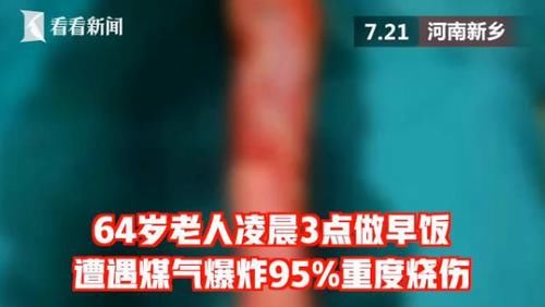  家中|家中厨房发生爆炸，母亲全身95％烧伤，儿子：身上的皮随时给我娘