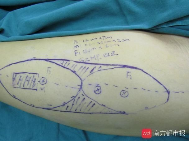  右手|挖大腿肉救伤残手 工伤导致右手溃烂，小心每年三个工伤高发季