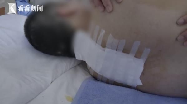  骨折|女子上班时从12楼坠落全身多处骨折 公司老板付了1万3失联