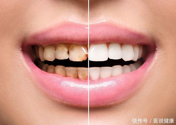 牙齿表面一摸闻着特别臭怎么解决(牙齿表面的“小黄石”，又臭又脏？想要去除它，不妨试试这6招！)